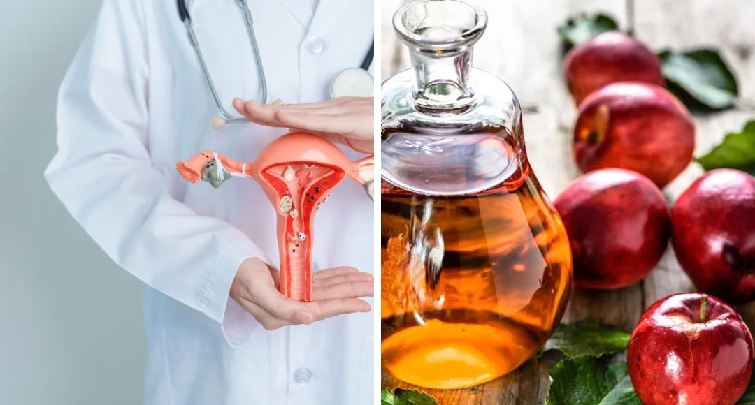 Irregular Periods, Try These Natural Remedies for a Healthy Cycle