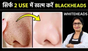 Blackhead Removal Tips: ब्लैकहेड्स हटाने के घरेलू उपाय, रसोई की इन चीजों से पाएं साफ और चमकदार त्वचा