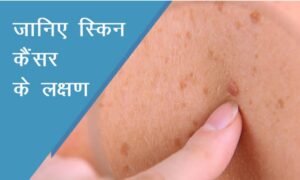 त्वचा पर नज़र आने वाले ये चेतावनी संकेत कर सकते हैं Skin Cancer की ओर इशारा, जानें इनके बारे में विस्तार से