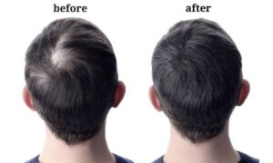 Hair Growth: पतले बालों को घना और स्वस्थ बनाने के लिए अपनाएं ये आयुर्वेदिक नुस्खें