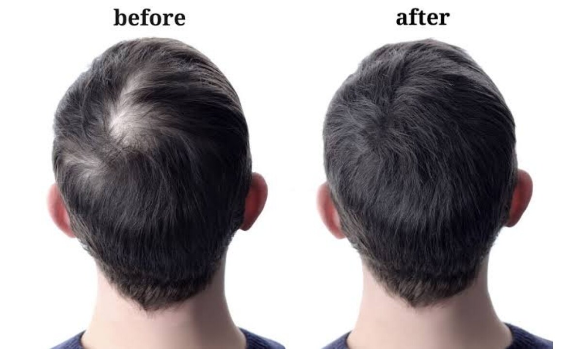 Hair Growth Problem