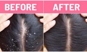 Scalp Care: सर्दियों के रूखेपन से बचने के लिए आयुर्वेदिक तरीकों से करें स्कैल्प की देखभाल