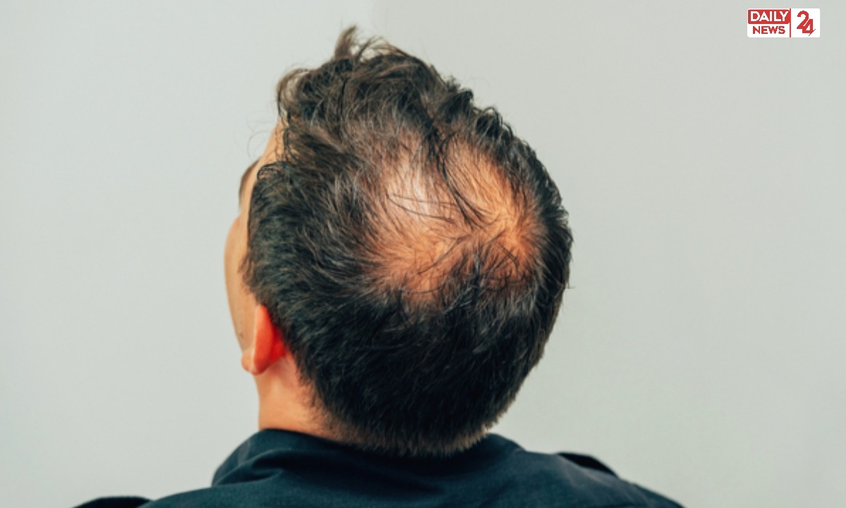 Hair line Hair Growth 