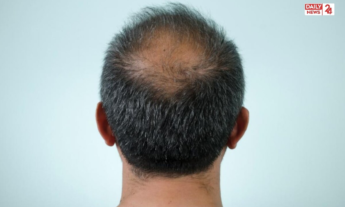 Hair line Hair Growth 