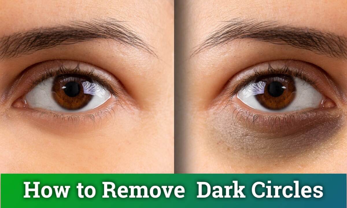 How To Remove Dark Circles