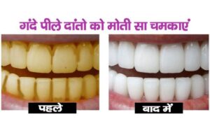 Teeth Care Tips: दांतों का पीलापन होगा गायब और मुस्कान होगी शानदार, घर पर ही आजमाय ये नुस्खे