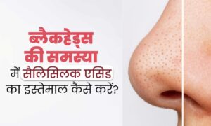 Skin Care: ब्लैकहेड्स और पिंपल्स की समस्या का हल है सैलिसिलिक एसिड, जानें इसके इस्तेमाल का सही तरीका