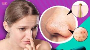 Skin Care Tips: चेहरे से ब्लैकहेड्स हटाने के लिए घर पर बनाएं ये असरदार पोर स्ट्रिप्स