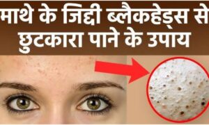 Skin Care: माथे के जिद्दी ब्लैकहेड्स से निजात पाने के लिए इन सरल और असरदार घरेलू उपायों का करें इस्तेमाल