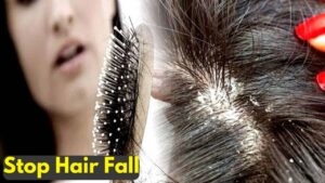 बालों का Hair Fall और Dandruff को कैसे हटाएं, देखे प्रभावी उपाय और टिप्स