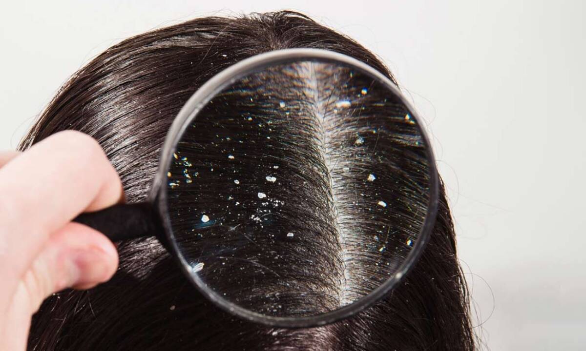 Dandruff Hair Care